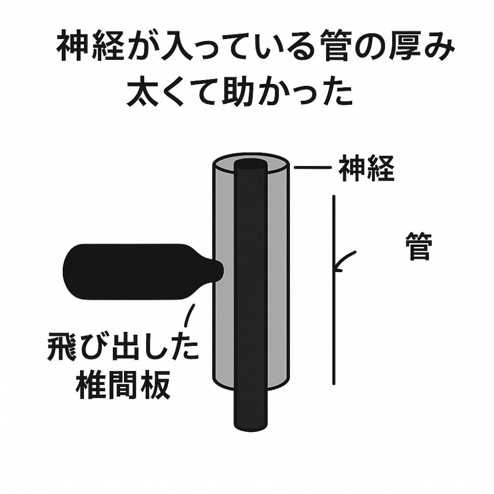 飛び出した椎間板と、神経が入っている管(ホース)を断面で示した図解。 太い管の中に神経が通っており、飛び出した椎間板が神経に接触しきっていない状態を表している。 上部には「神経が入っている管の厚み 太くて助かった」という解説が書かれている。